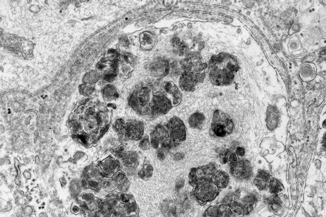 La formazione dei corpi di Lewy all'interno dei neuroni (fonte:&nbsp;Armin Bayati from Peter McPherson Lab, The Neuro)