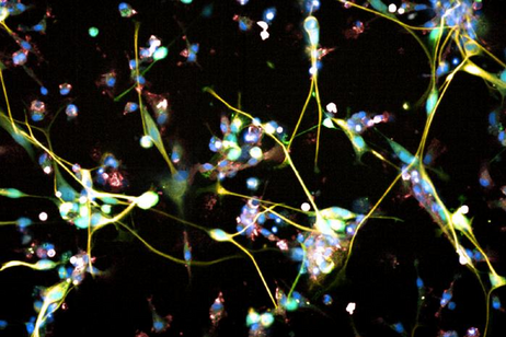 Cellule di glioblastoma (fonte: Sohyon Lee e Berend Snijeder / ETH Zurigo)